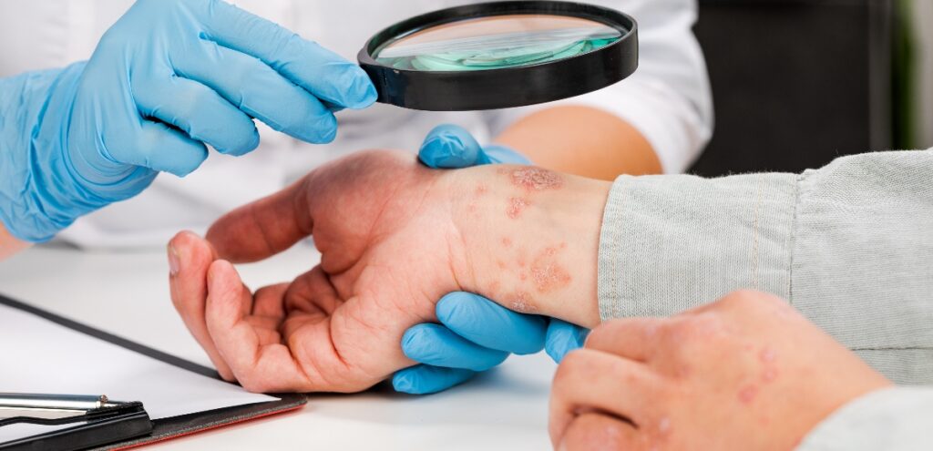 eczema