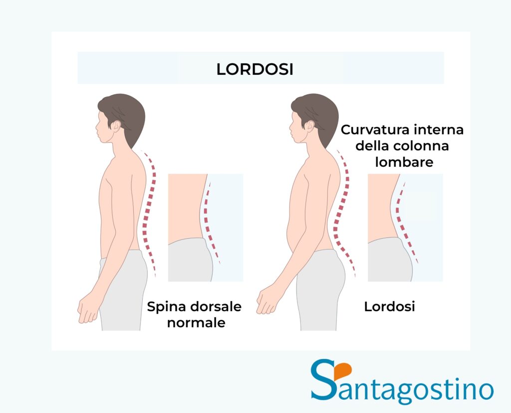 Lordosi santagostino garbatella