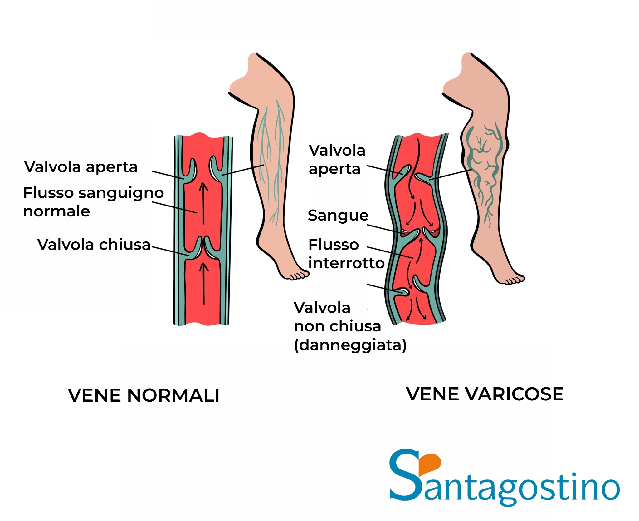 Vene Rulla Le vene varicose o varici - Santagostino Garbatella