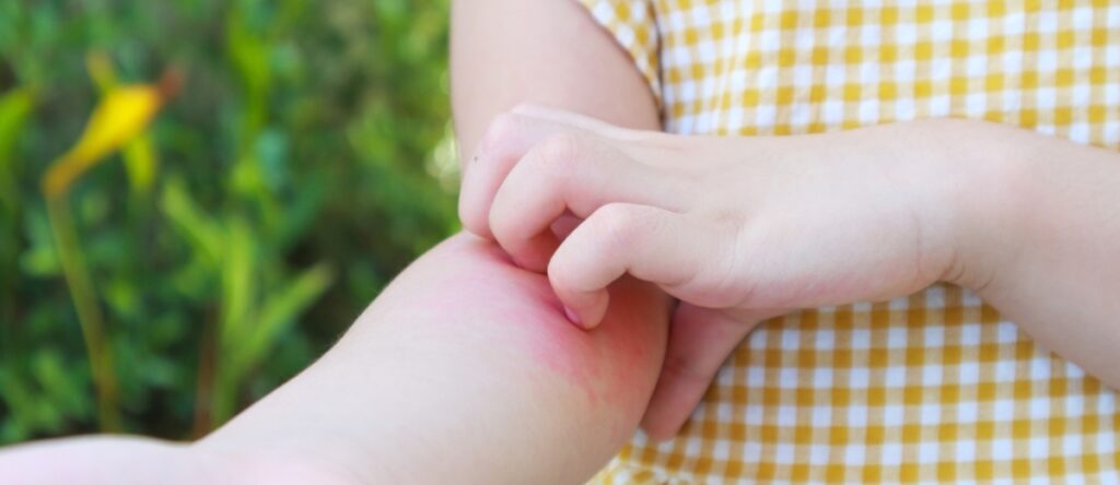 orticaria santagostino garbatella