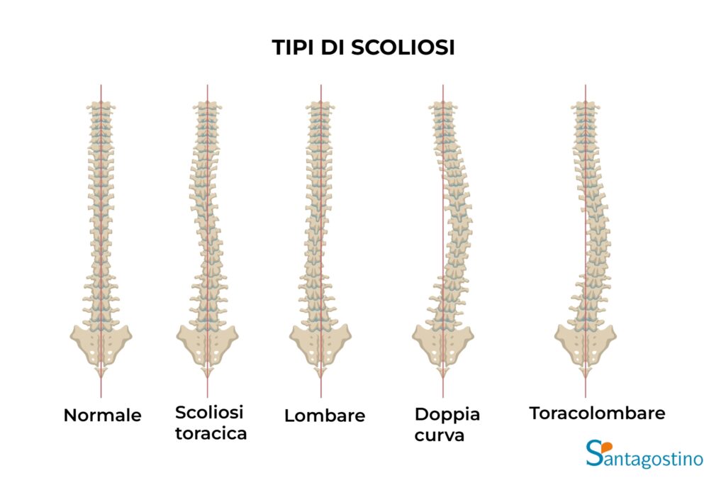 tipi di scoliosi santagostino garbatella