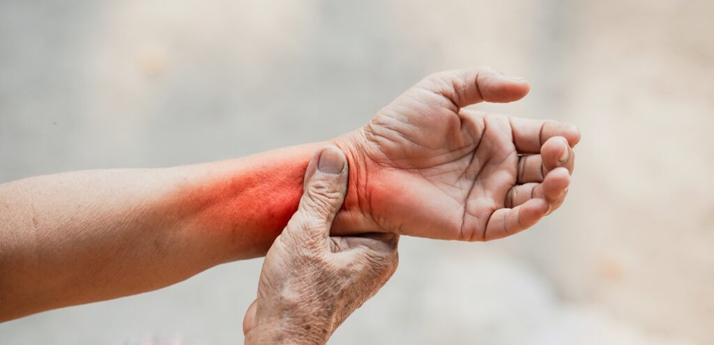 sindrome del tunnel carpale