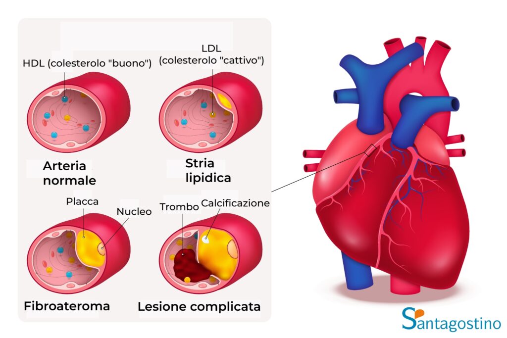 aterosclerosi santagostino garbatella