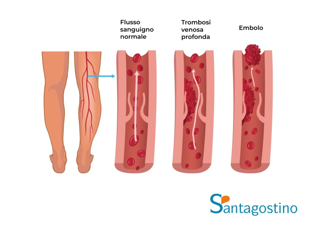 trombosi venosa profonda santagostino garbatella