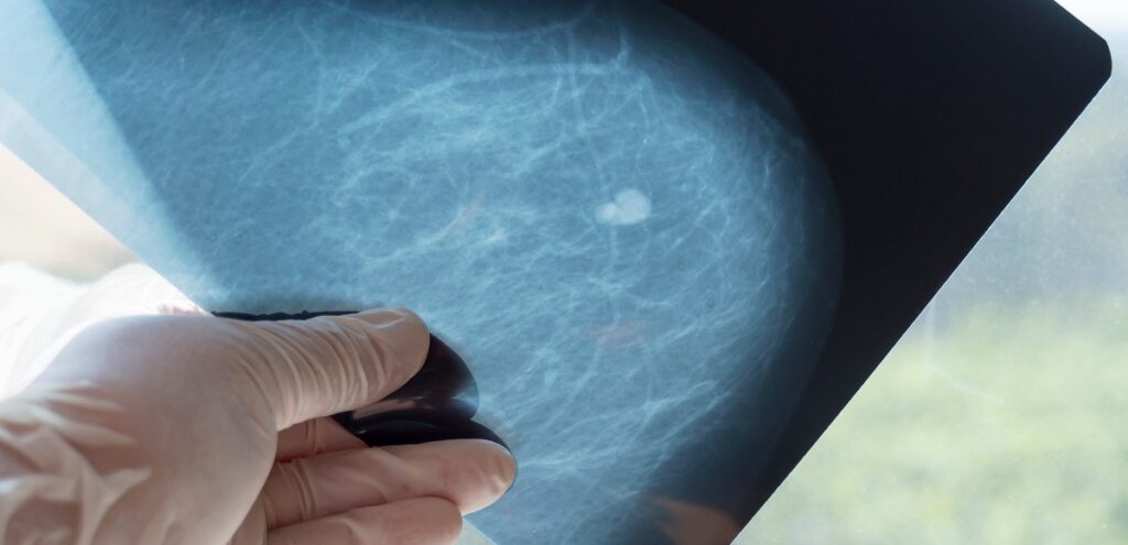 mammografia